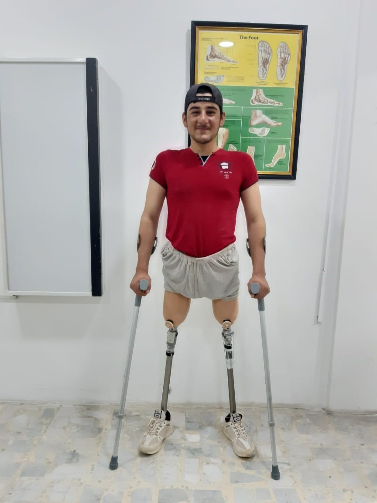 Ismael, amputee of both legs, learns to walk with his prostheses