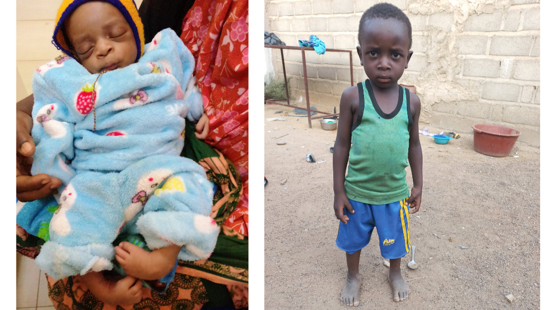 Clubfoot correction in Burkina Faso
