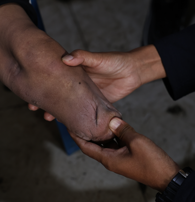 Two hands holding a leg which has been amputated.