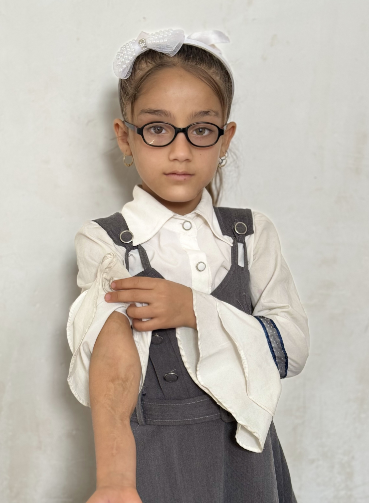 A girl shows her arm. It is covered with scars.