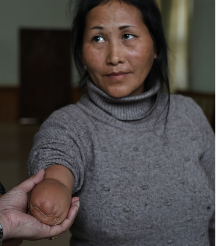 A hand holding a woman’s arm. She has been amputated below the elbow.